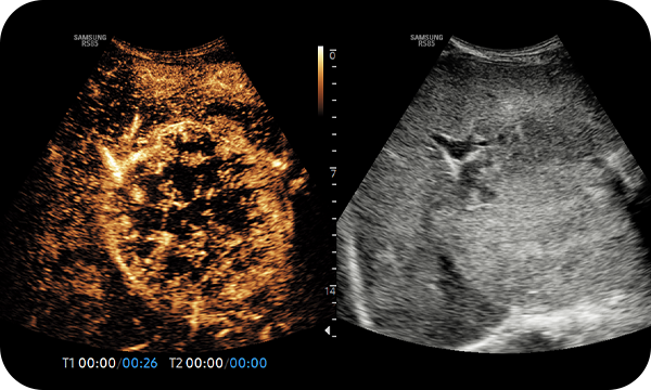 CEUS+: contrast enhanced ultrasound