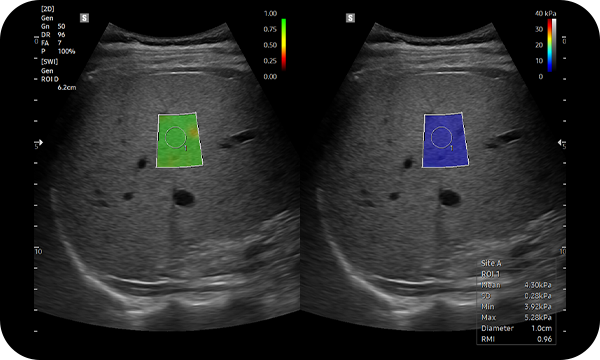  S-Shearwave Imaging™ : liver diagnosis Solutions