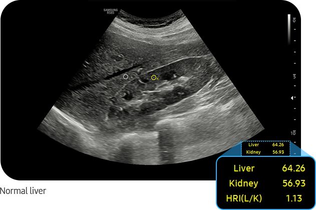 EzHRI™ : Normal liver ultrasound images