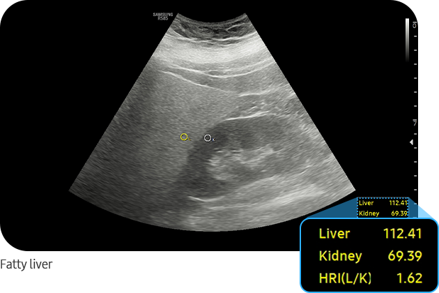 EzHRI™ : ultrasound images of fatty liver