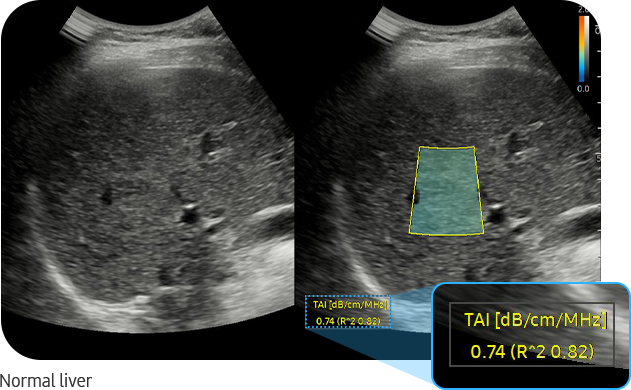TAI™ : normal liver on ultrasound