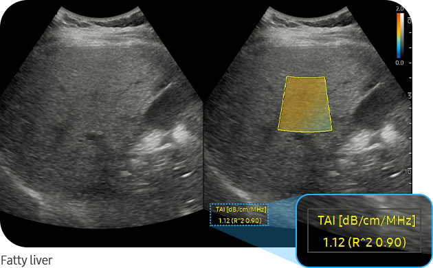 TAI™ : fatty liver images ultrasound