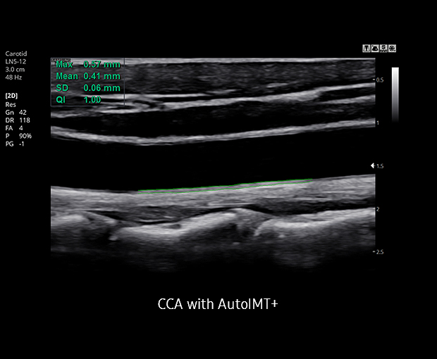 Auto IMT+™ Sample