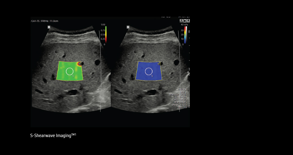 ultrasound for liver EzHRI™ ¹