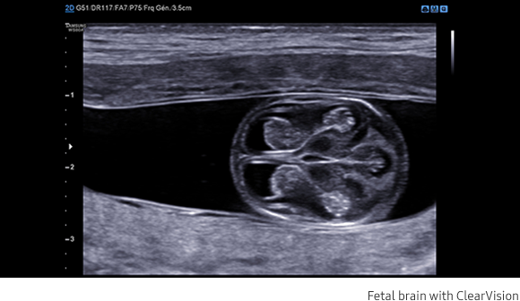 Fetal brain with ClearVision