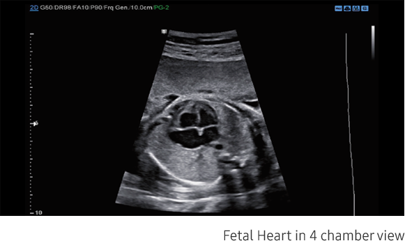 Fetal Heart in 4 chamber view