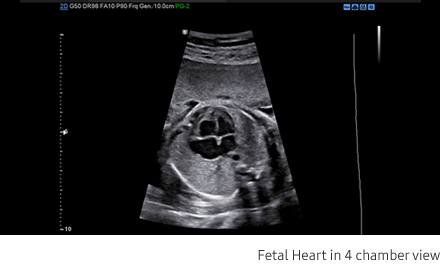 Fetal Heart in 4 chamber view