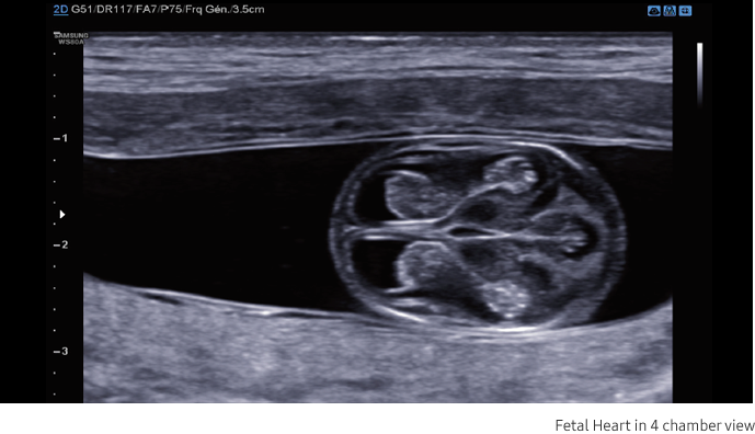 Fetal Heart in 4 chamber view