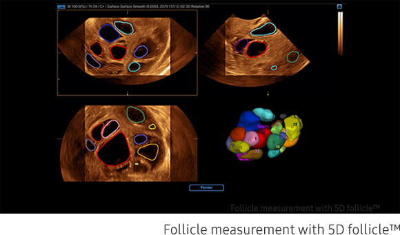 Follicle measurement with 5D follicle™