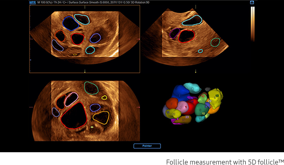 Follicle measurement with 5D follicle™