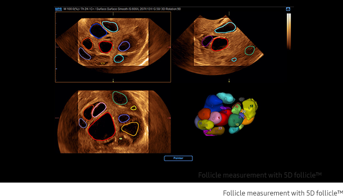 Follicle measurement with 5D follicle™