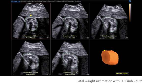 Fetal weight estimation with 5D Limb Vol.™