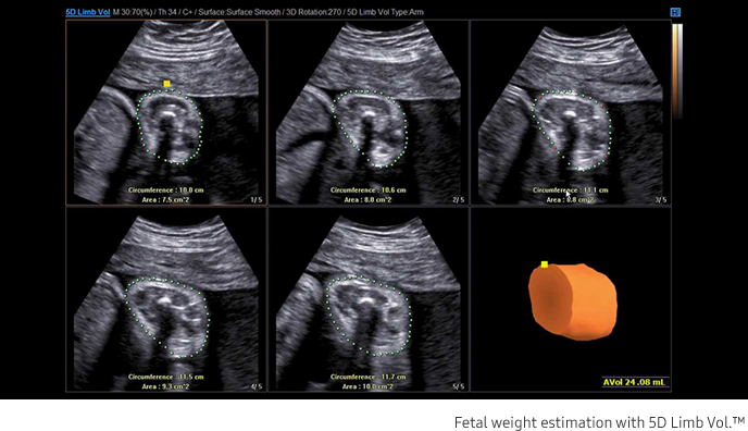 Fetal weight estimation with 5D Limb Vol.™