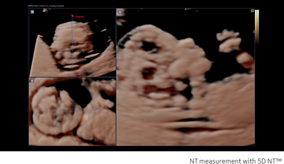 Fetal brain measurement with 5D CNS+™