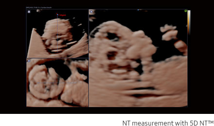 Fetal brain measurement with 5D CNS+™