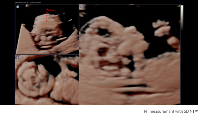 Fetal brain measurement with 5D CNS+™