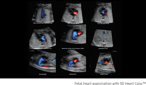 Fetal brain measurement with 5D CNS+™