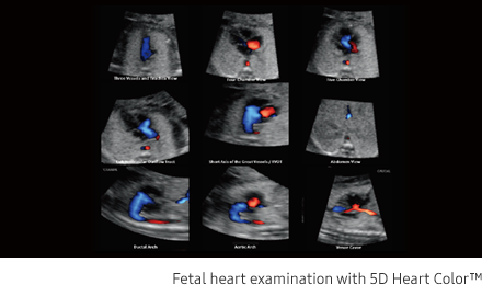 Fetal brain measurement with 5D CNS+™