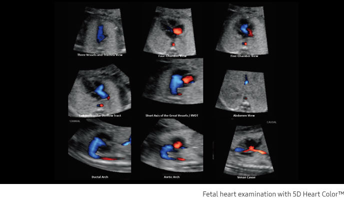 Fetal brain measurement with 5D CNS+™