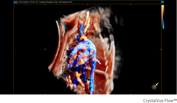 Fetal circulation in CrystalVue Flow™