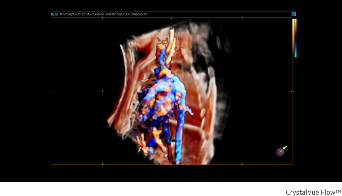 Fetal circulation in CrystalVue Flow™