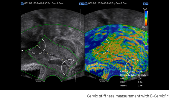 Cervix stiffness measurement with E-Cervix™