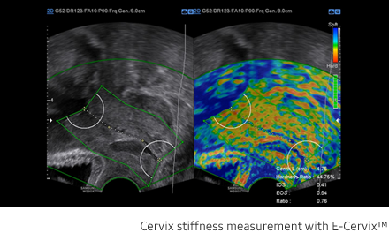 Cervix stiffness measurement with E-Cervix™