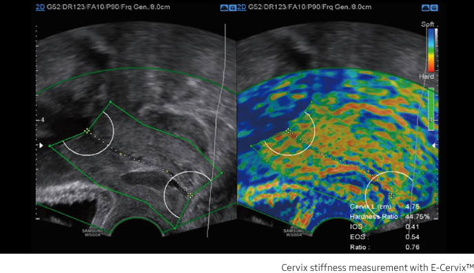 Cervix stiffness measurement with E-Cervix™