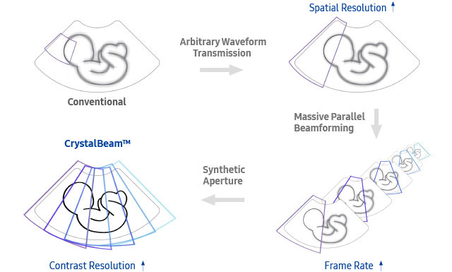 fetal images of ob gyn ultrasound : Conventional, fetal images of ultrasound obgyn : Better Spatial Resolution, fetal images of ultrasound ob gyn : Higher Frame Rate, Fetal images of obgyn ultrasound : More detailed and faster beam process