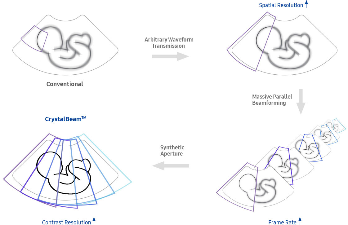 fetal images of ob gyn ultrasound : Conventional, fetal images of ultrasound obgyn : Better Spatial Resolution, fetal images of ultrasound ob gyn : Higher Frame Rate, Fetal images of obgyn ultrasound : More detailed and faster beam process