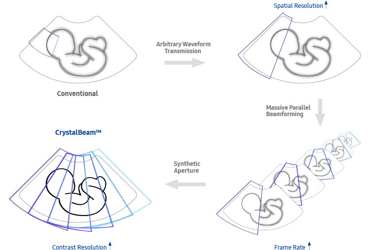 fetal images of ob gyn ultrasound : Conventional, fetal images of ultrasound obgyn : Better Spatial Resolution, fetal images of ultrasound ob gyn : Higher Frame Rate, Fetal images of obgyn ultrasound : More detailed and faster beam process