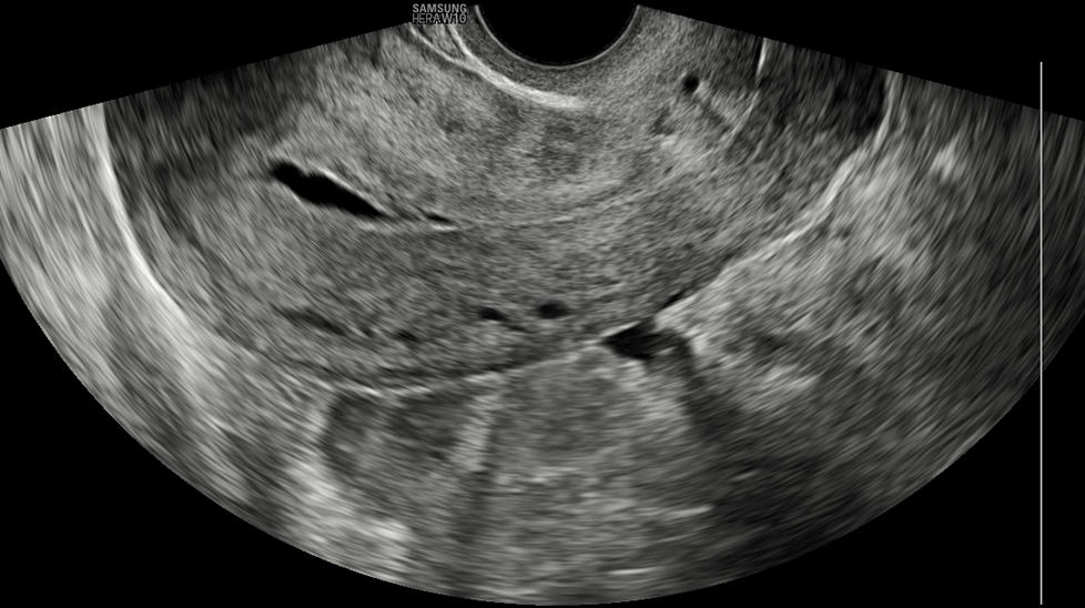 Uterus with S-Harmonic™