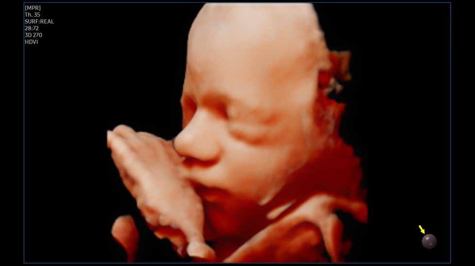 powerful imaging : Fetal face with RealisticVue™