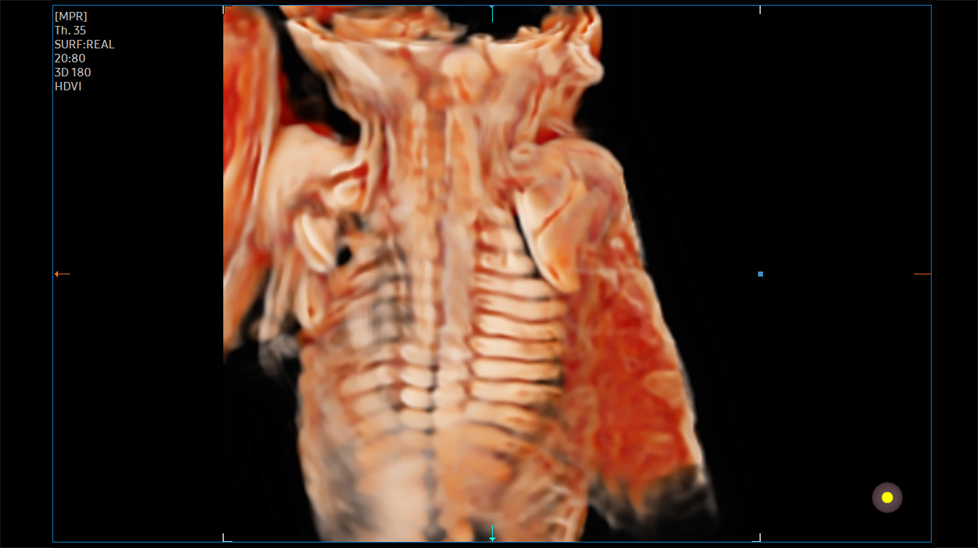 3d imaging of ultrasound imaging machines : Fetal Spine with CrystalVue™