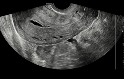 Uterus with S-Harmonic™