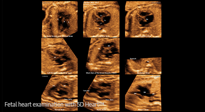 cardiac solutions : 5D Heart™