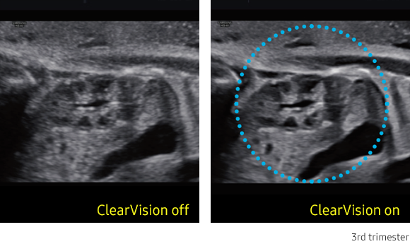 ClearVision™ Sample