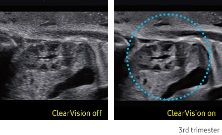 ClearVision™ Sample