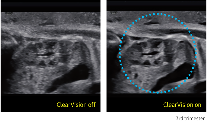 ClearVision™ Sample