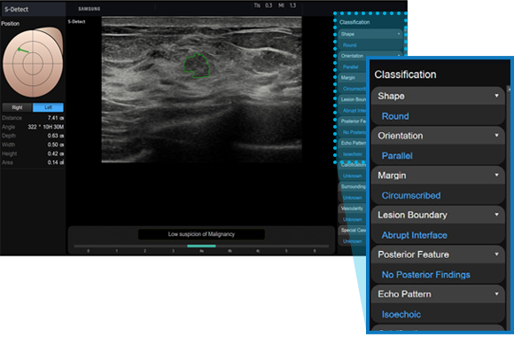 S-Detect™ for Breast