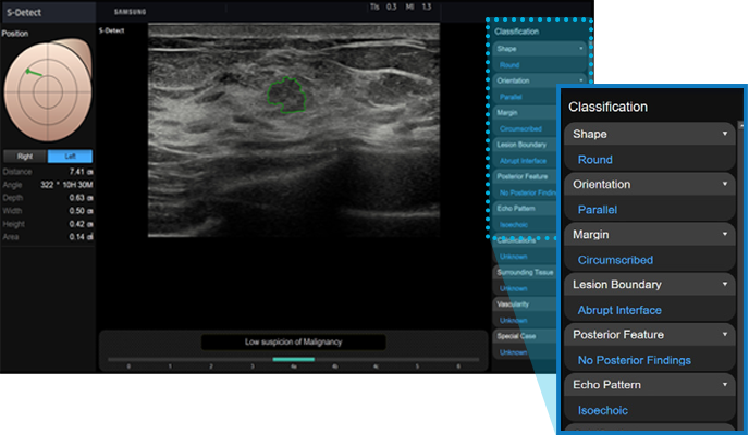 S-Detect™ for Breast