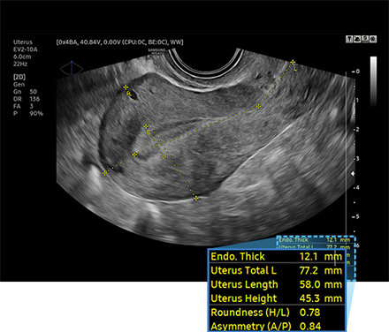 UterineAssist