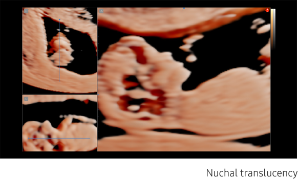 Nuchal translucency