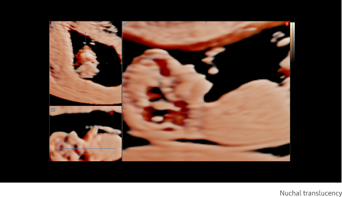 Nuchal translucency