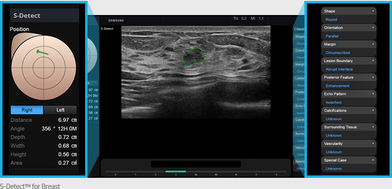 S-Detect™ for Breast