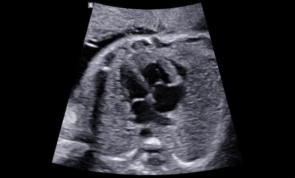 2d images : Fetal heart 4ch view