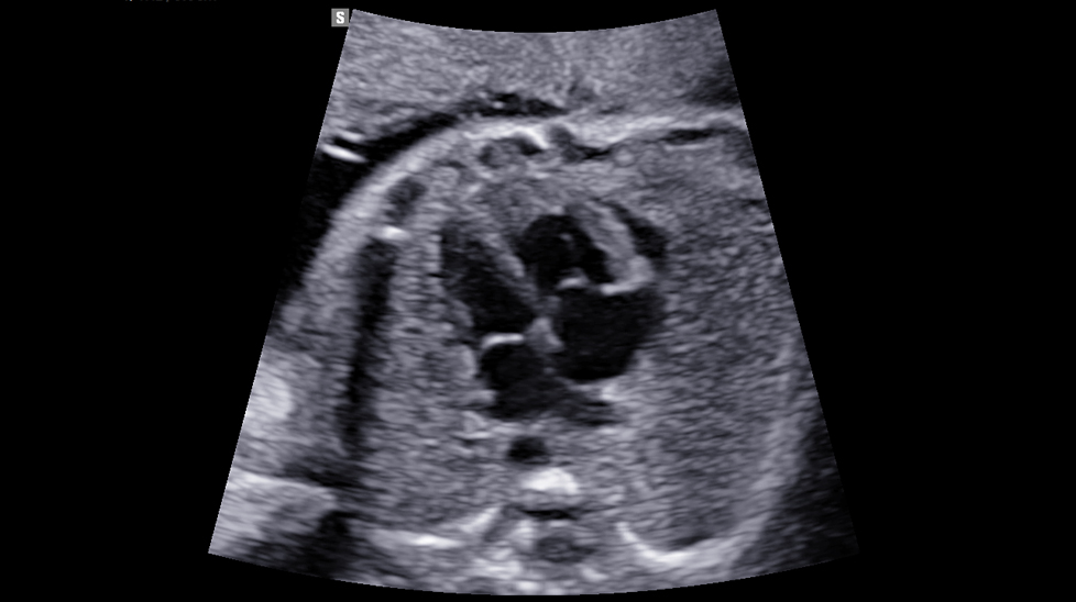 2d images : Fetal heart 4ch view