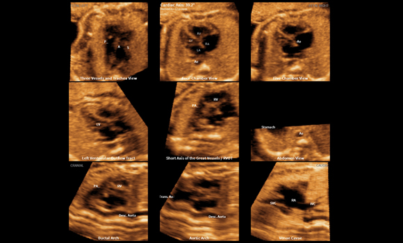 medical diagnostics : 9 fetal heart standard views with 5D Heart Color™