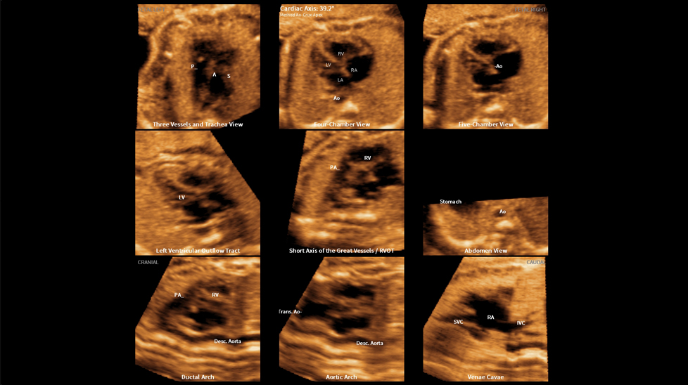 medical diagnostics : 9 fetal heart standard views with 5D Heart Color™