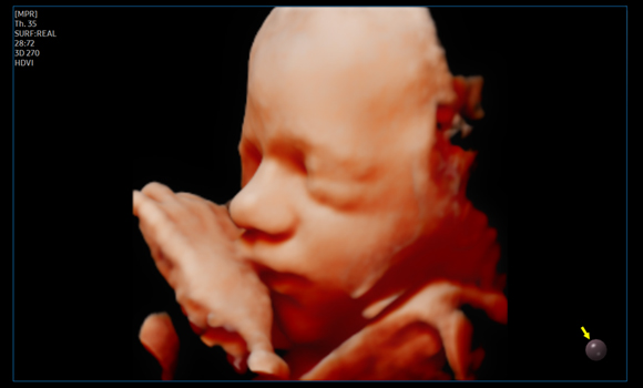 3d imaging : Fetal face with RealisticVue™